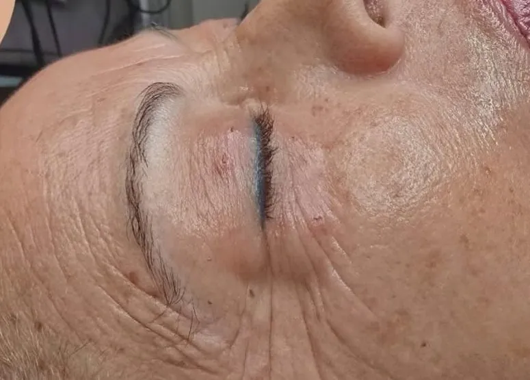 Después del tratamiento: Contorno de ojos y entrecejo